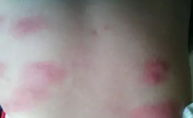 宝宝被蚊子咬伤